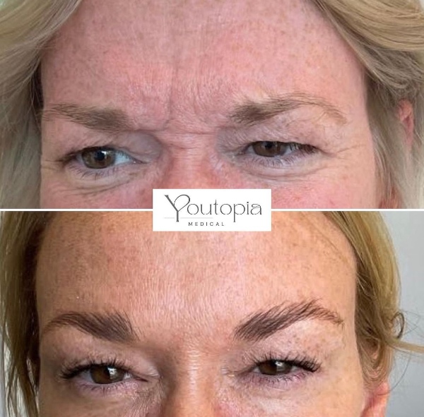 Anti Wrinkle Injections YouTopia Medical Aesthetics Clinic (1)