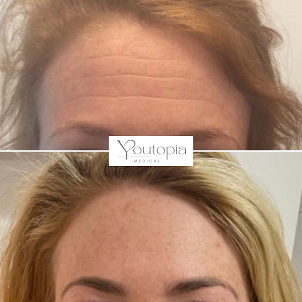 Anti Wrinkle Injections YouTopia Medical Aesthetics Clinic (4)