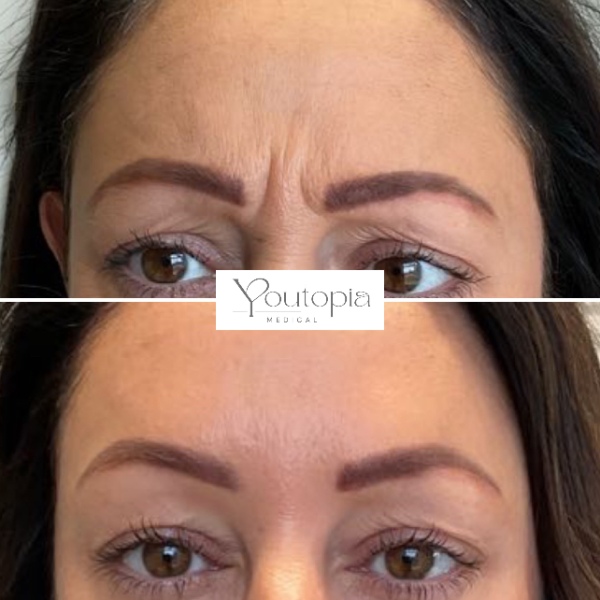 Anti Wrinkle Injections YouTopia Medical Aesthetics Clinic (8)