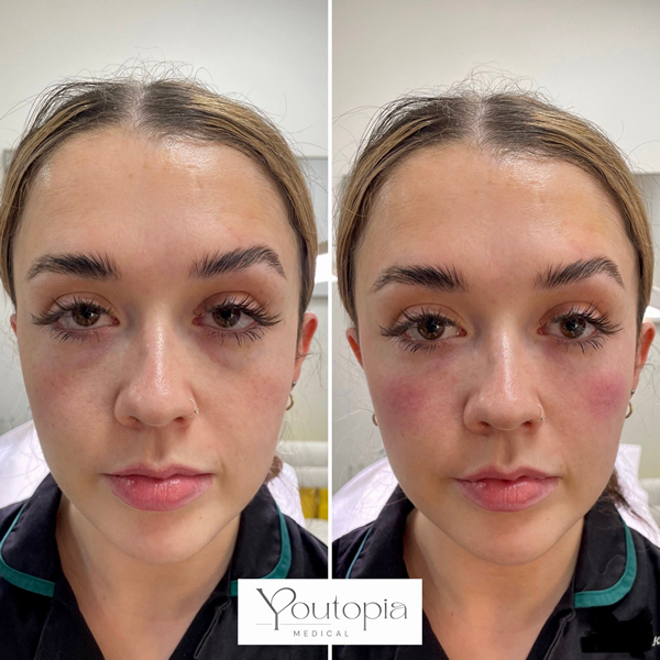 Mid Face Fillers YouTopia Medical Aesthetics Clinic 1