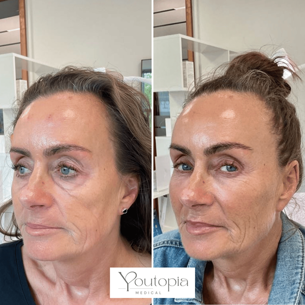 Mid Face Fillers YouTopia Medical Aesthetics Clinic 2