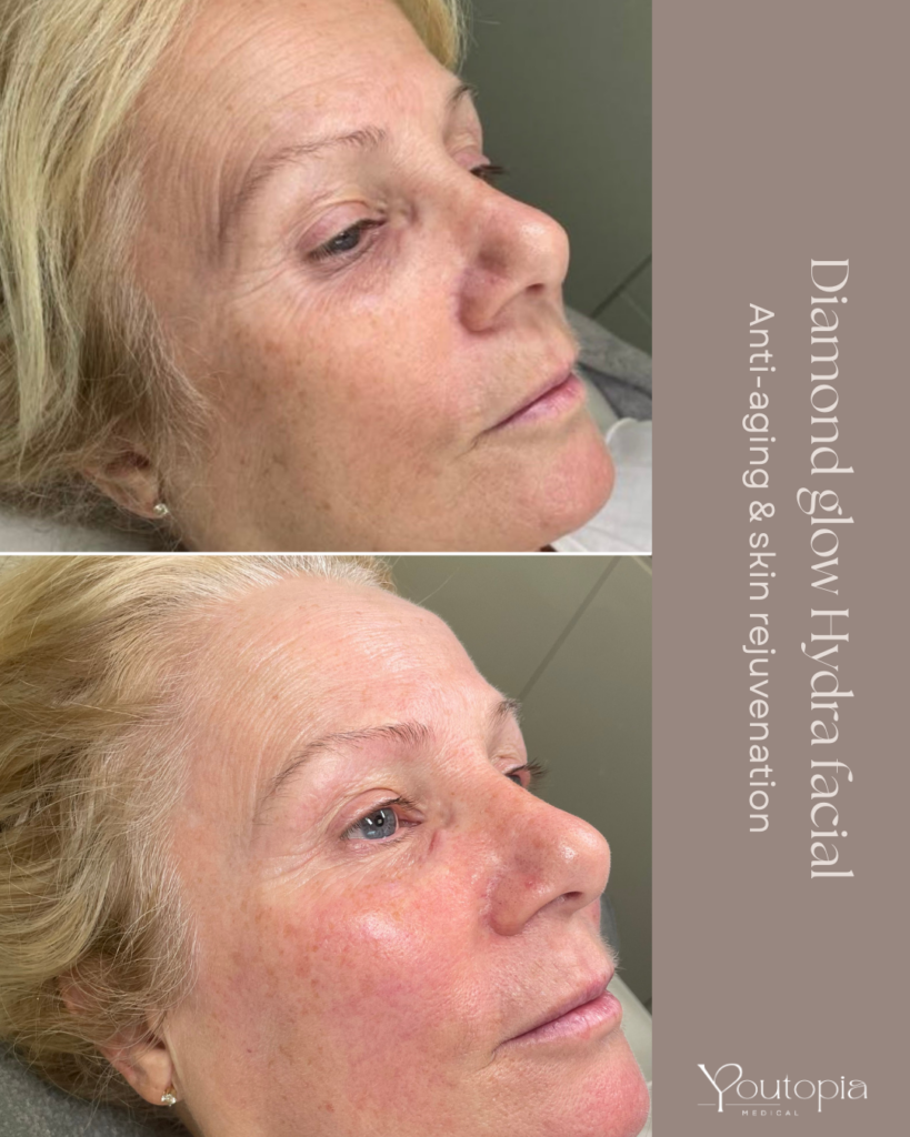 Before & After Images from our DiamondGlow HydraFacial