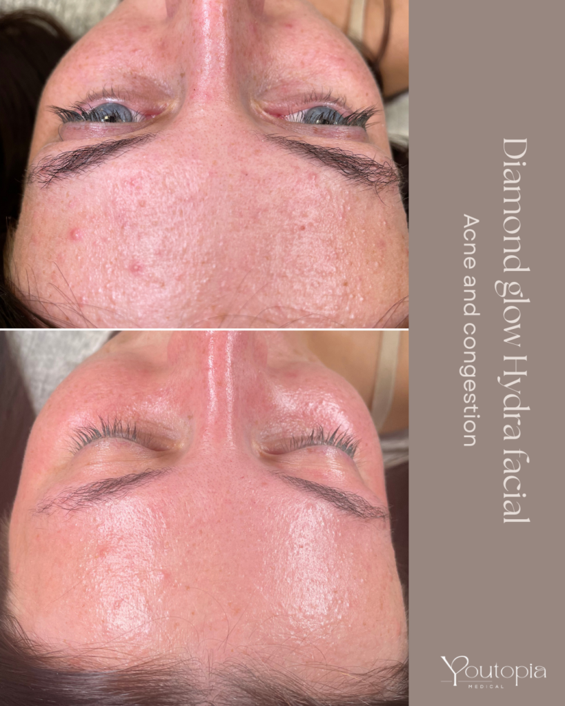 Before & After Images from our DiamondGlow HydraFacial