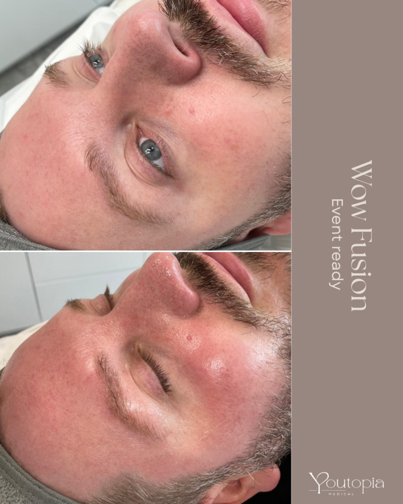 Before & After Images from our WOW Fusion Facial