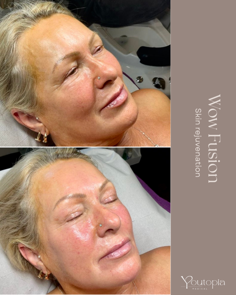 Before & After Images from our WOW Fusion Facial