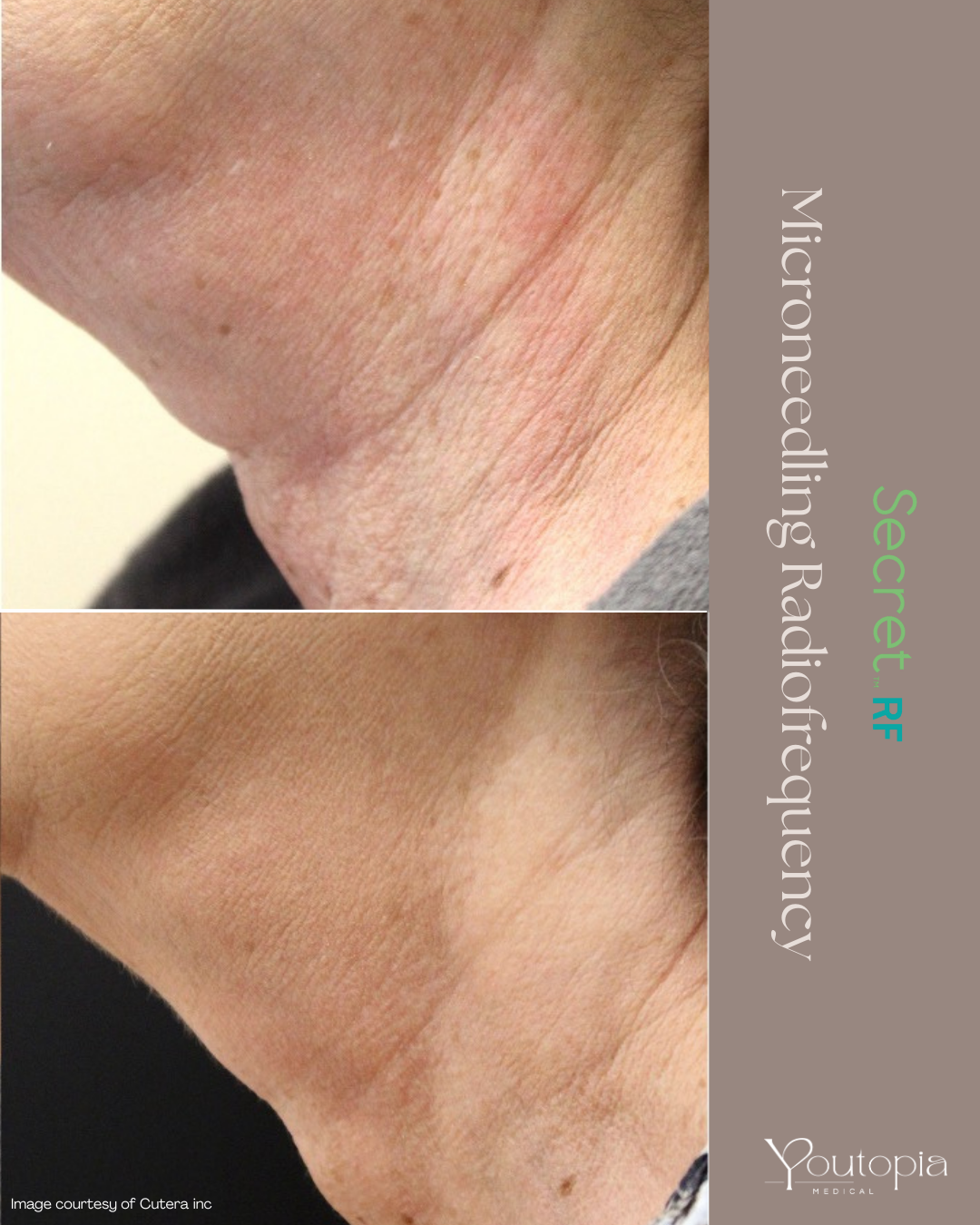 Before and After Neck