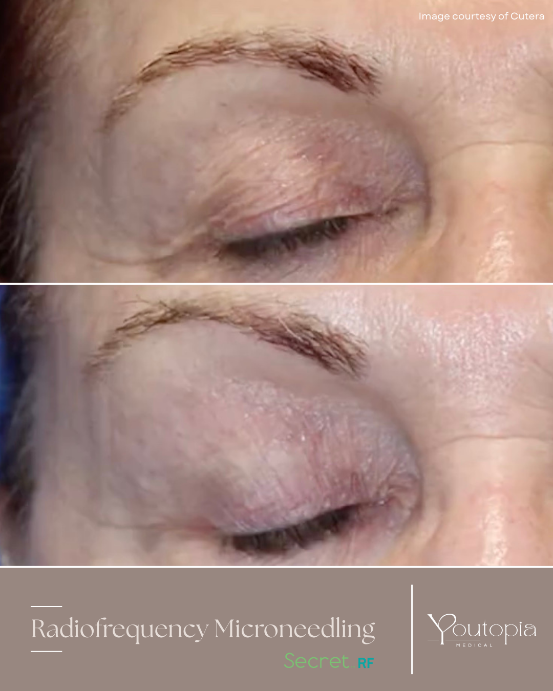 Before and After Upper eye lid