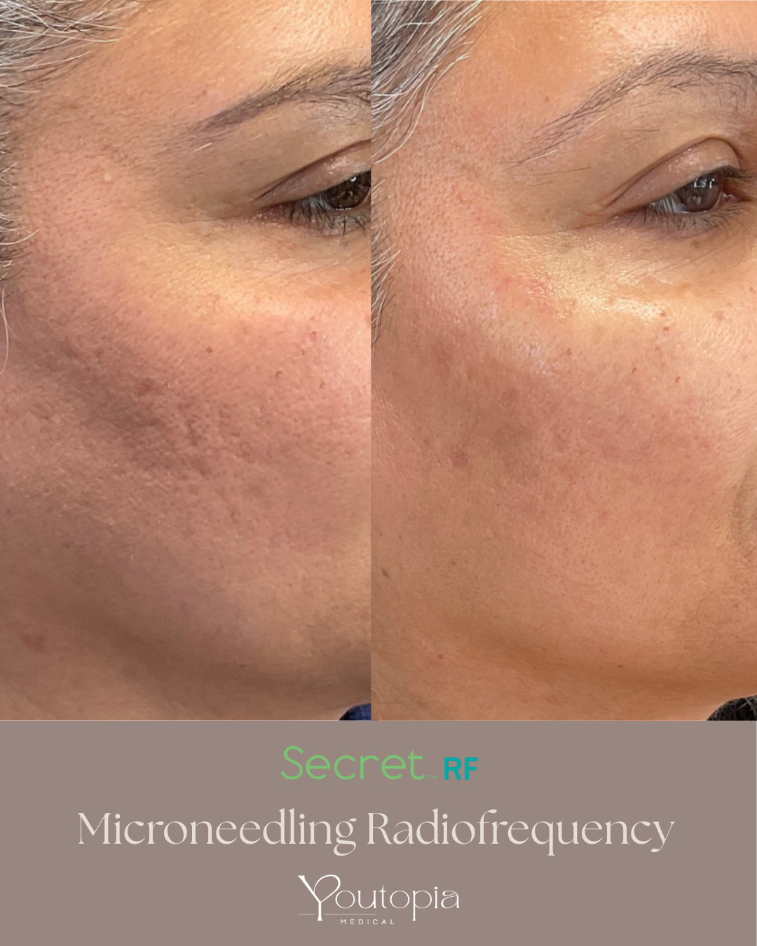 Before and after Mature acne scaring