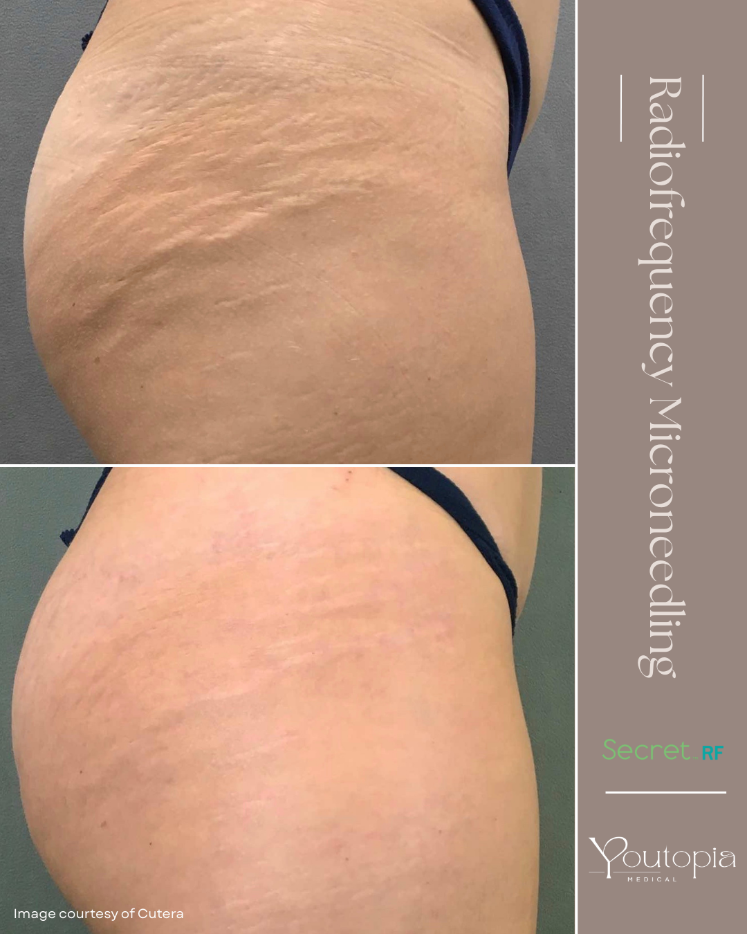 Before and after cutter stretch marks bum