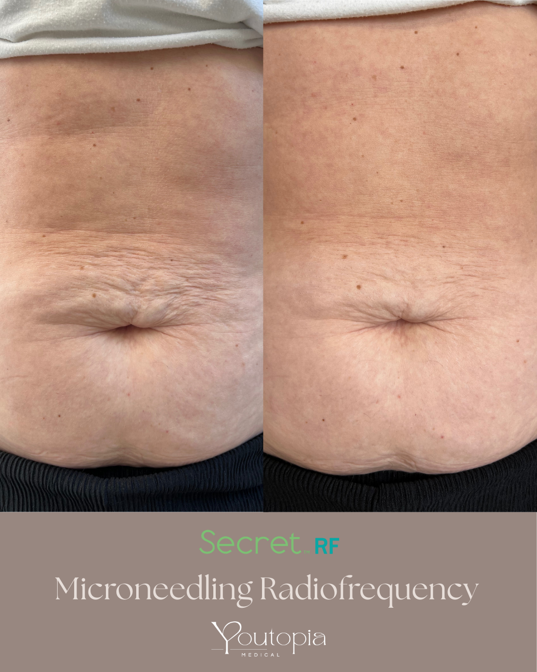 Before and after secret rf stomach