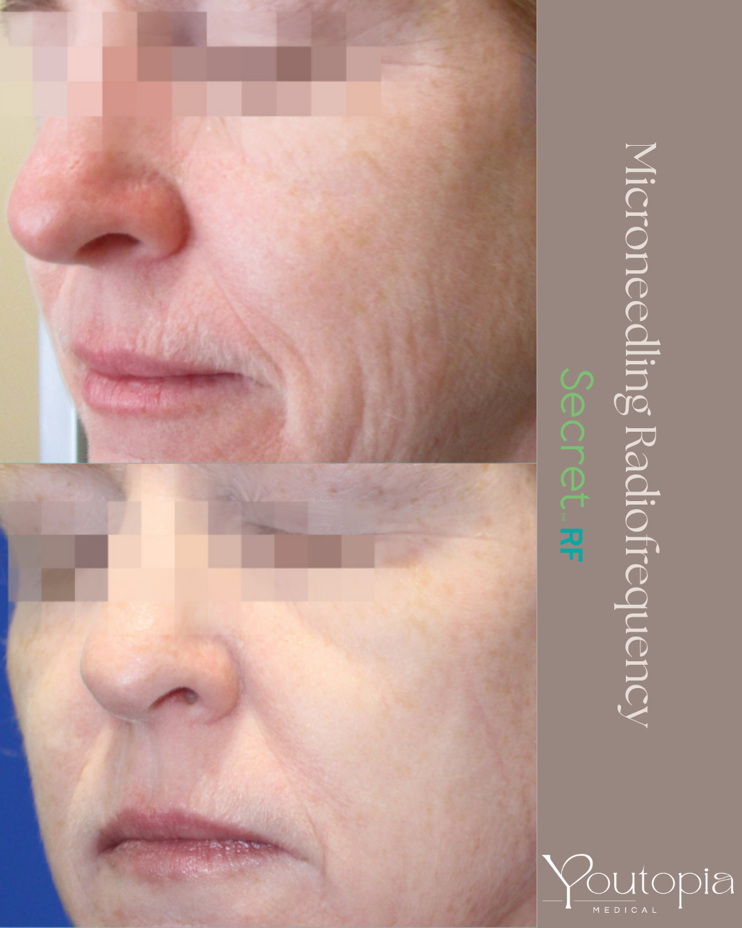 Buccal area lines and wrinkles before and after