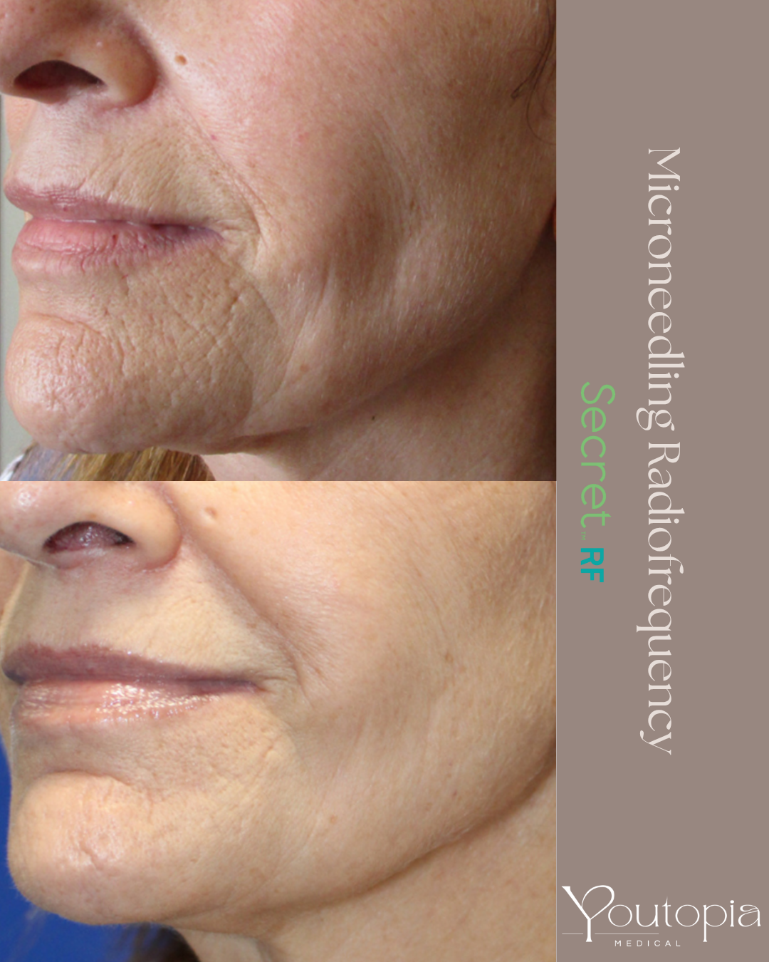 Skin elasticity improvement before and after
