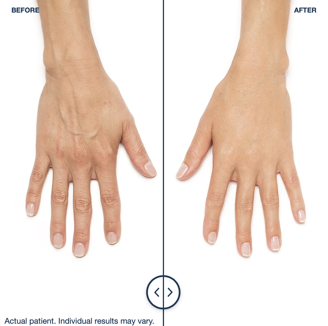 Before and After Hands