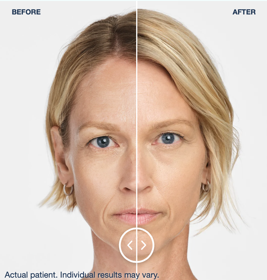 Before and After at 4 weeks