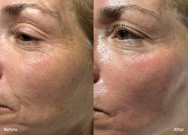 Image Hydrafacial B&A 2