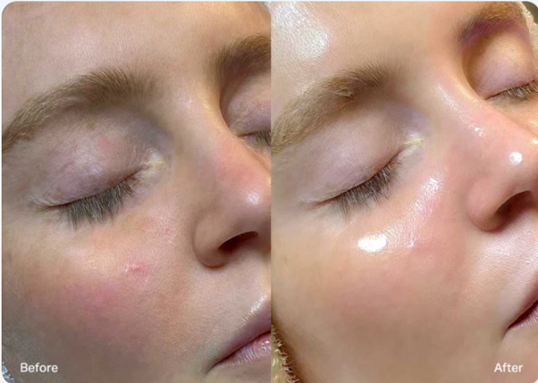 Image Hydrafacial B&A 3
