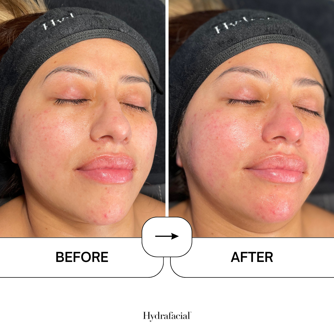 Image Hydrafacial B&A 5