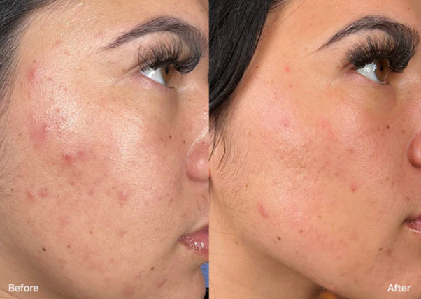 Image Hydrafacial B&A