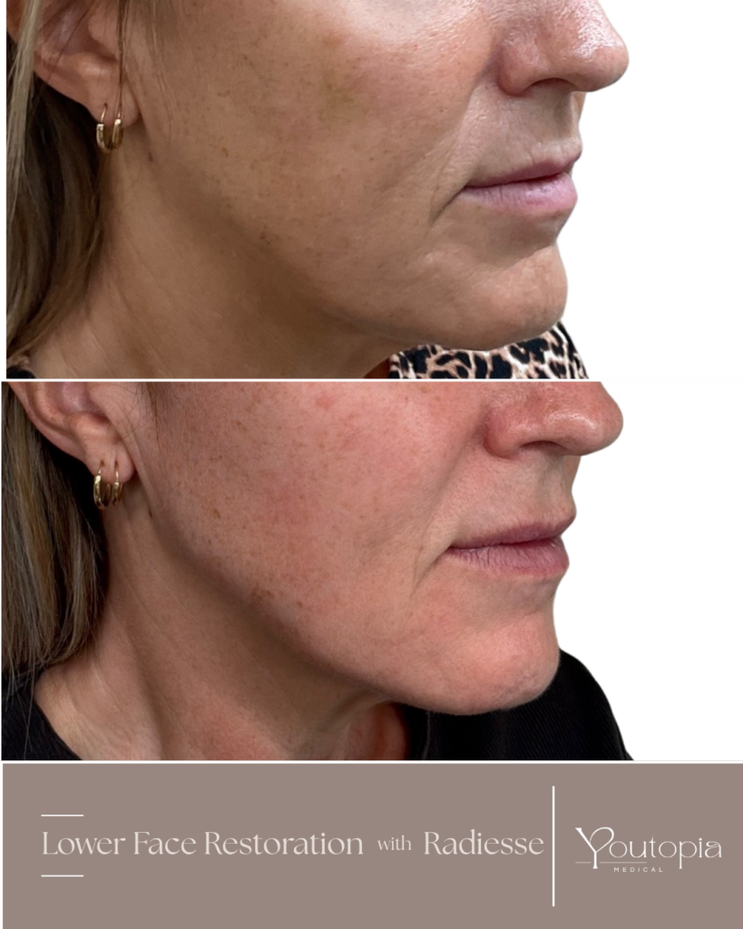 Radiesse before and after at Youtopia